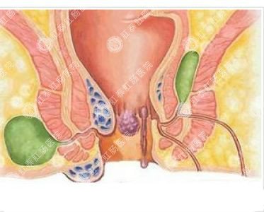 南寧哪個醫(yī)院可以做肛周膿腫？