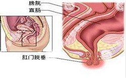 南寧治療脫肛哪家醫(yī)院好？南寧脫肛治療多少錢？